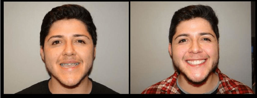 Before & After