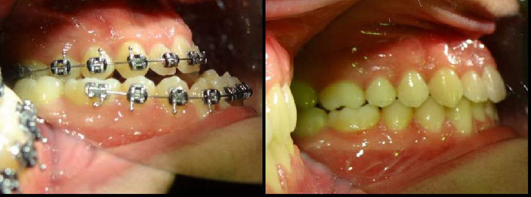 Corrective Jaw Surgery Before & After