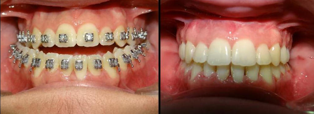 Corrective Jaw Surgery Before & After