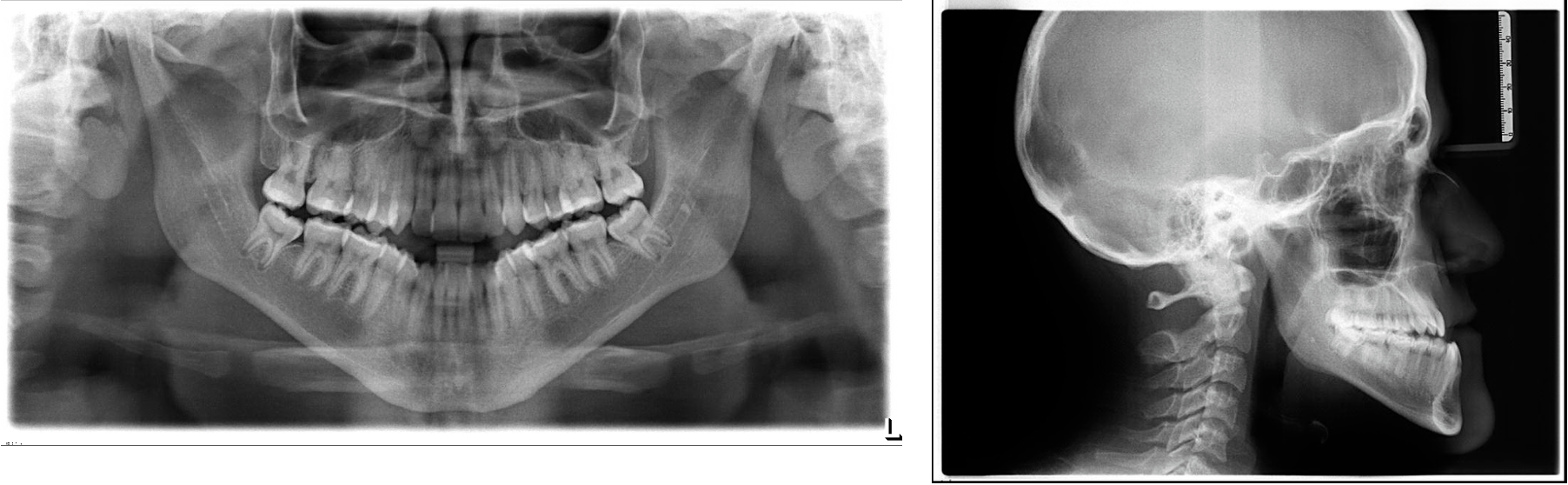 Corrective Jaw Surgery Before Xray