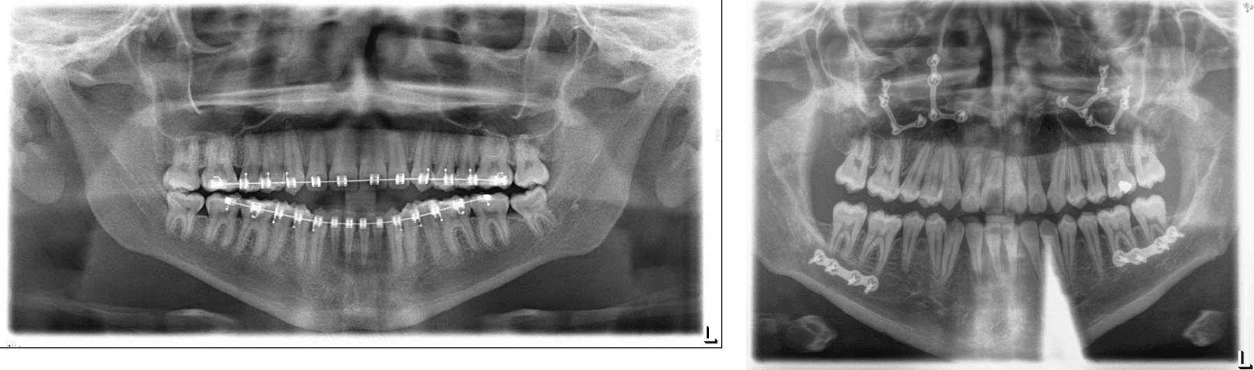 Corrective Jaw Surgery Xray With Braces