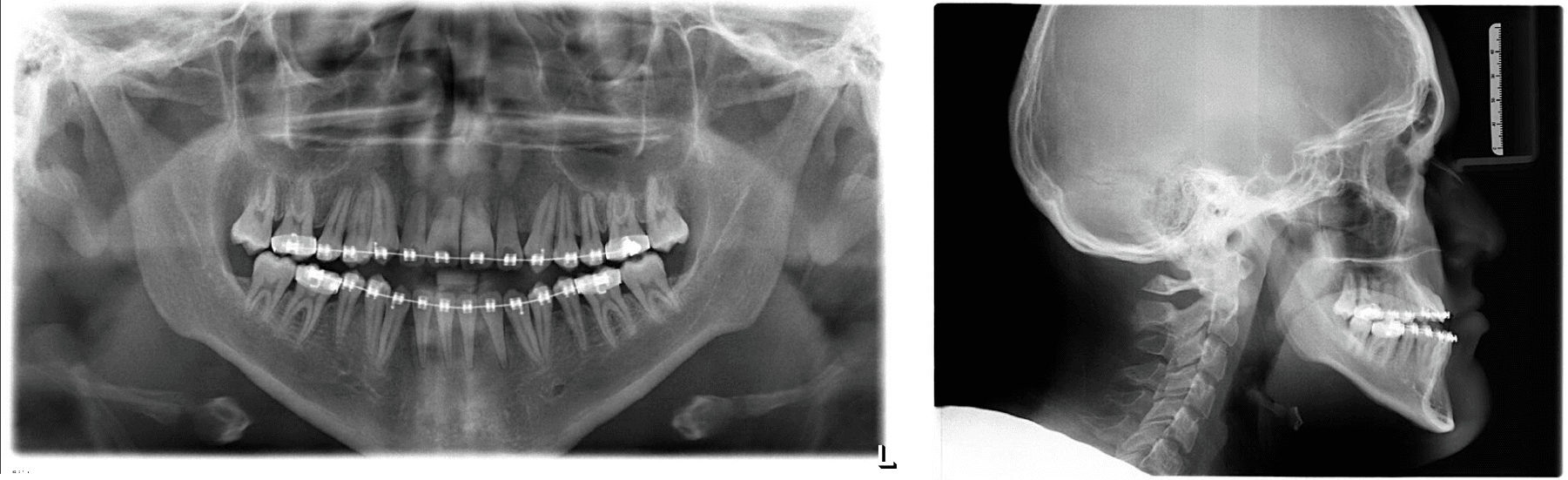 Corrective Jaw Surgery Xray