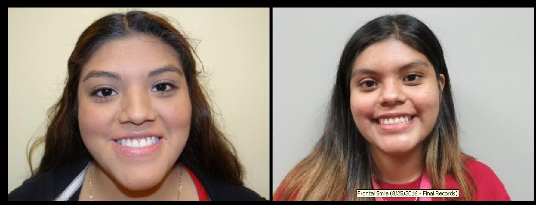 Corrective Jaw Surgery Before & After