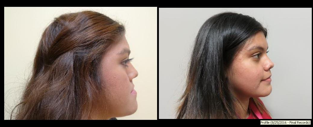 Corrective Jaw Surgery Before & After