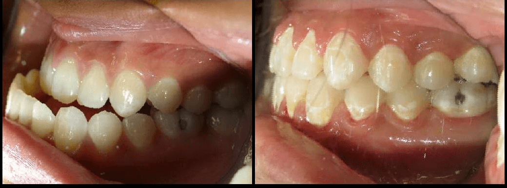 Corrective Jaw Surgery Before & After